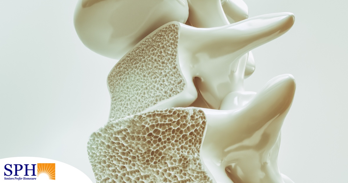 An image of a spine with the inside exposed represents osteoporosis.